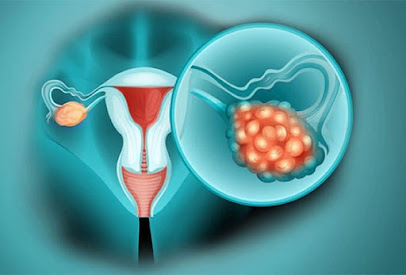 Fighting Ovarian Cancer