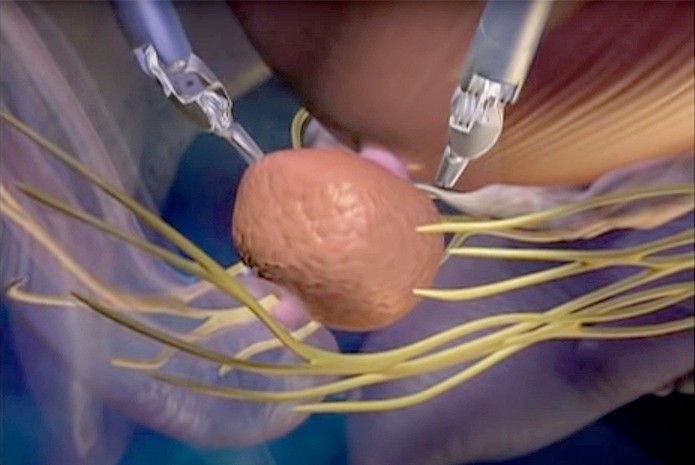 Prostate Cancer Robotic Surgery