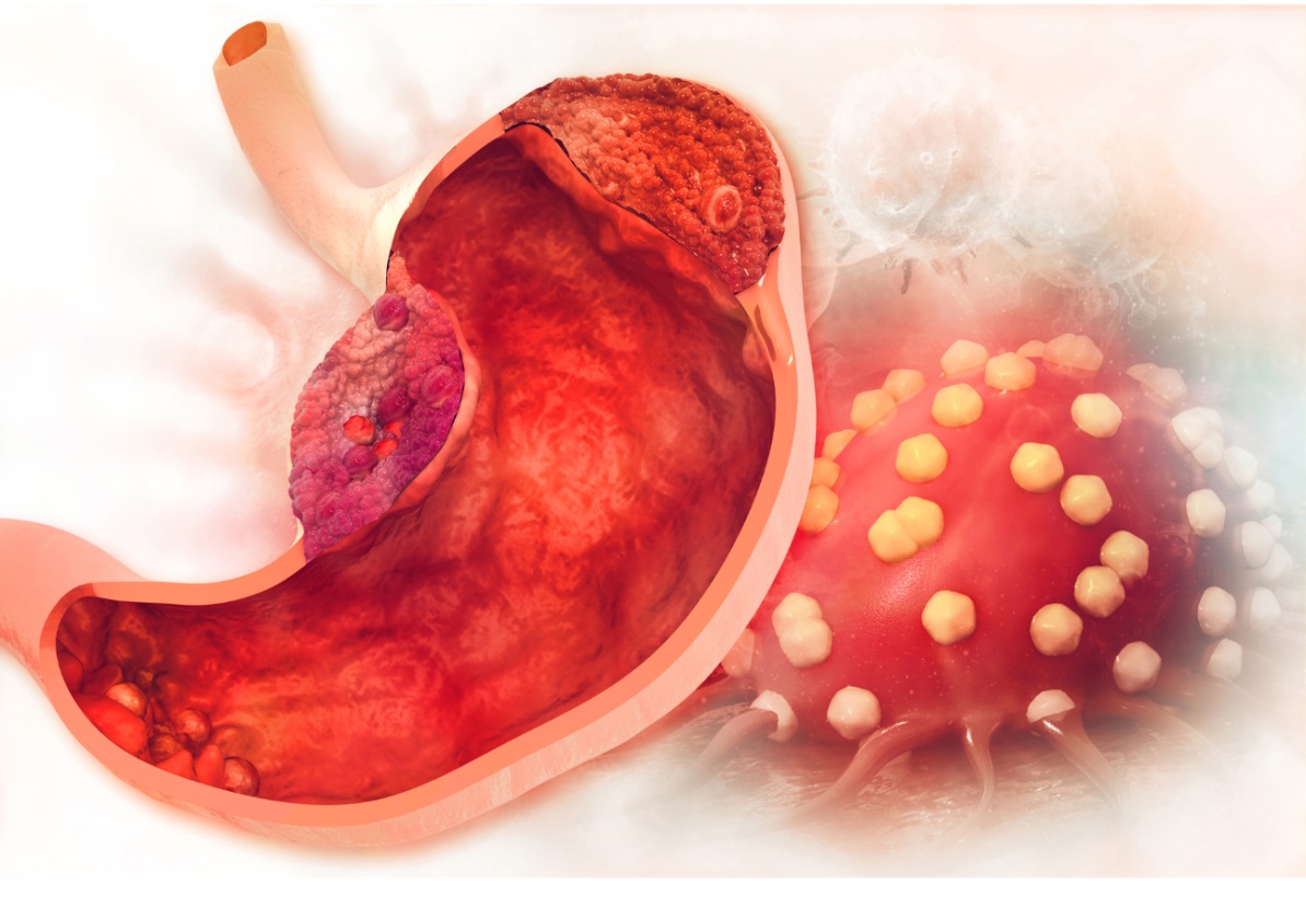 Diet-lifestyle-tips-to-reduce-stomach-cancer-risk